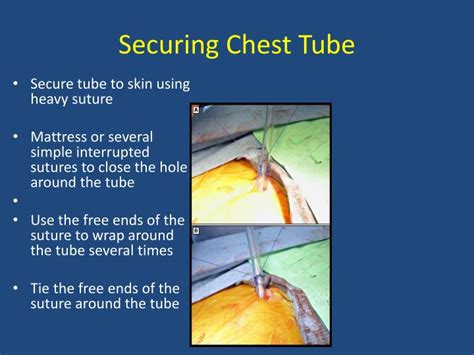 Ppt Chest Tube Insertion And Needle Decompression Powerpoint