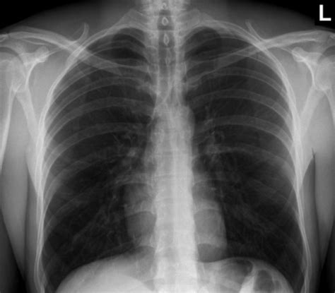 Pa cxr showing rt upper lung cavity with relatively. healthy: Normal Healthy Chest X Ray