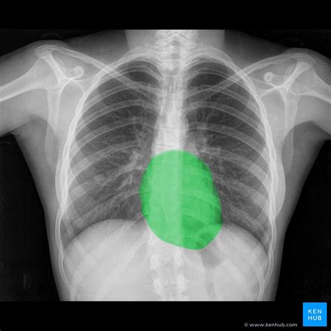 How To Interpret A Chest X Ray Lesson 5 Cardiac Silho
