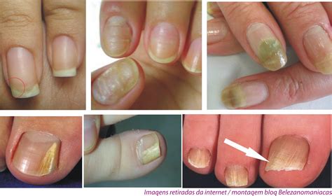 Veja mais ideias sobre fungos nas unhas, fungos, remédio para fungos. Remedio Para Micose De Unha Do Pé