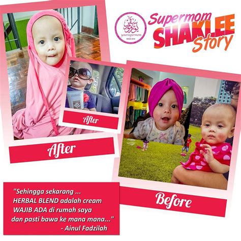 Sangat mungkin virus campak akan menulari bayi. Cara Ubat Demam Campak - Contoh Ita