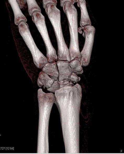 Fracture Dislocation Of The Carpal Bones Musculoskeletal Case Studies