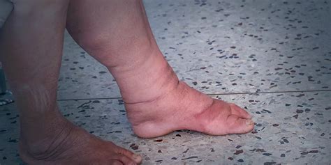 Elephantiasis Breast