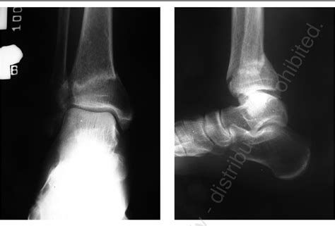 Figure 1 From Bilateral Stress Fracture Of Distal Fibula And Tibia