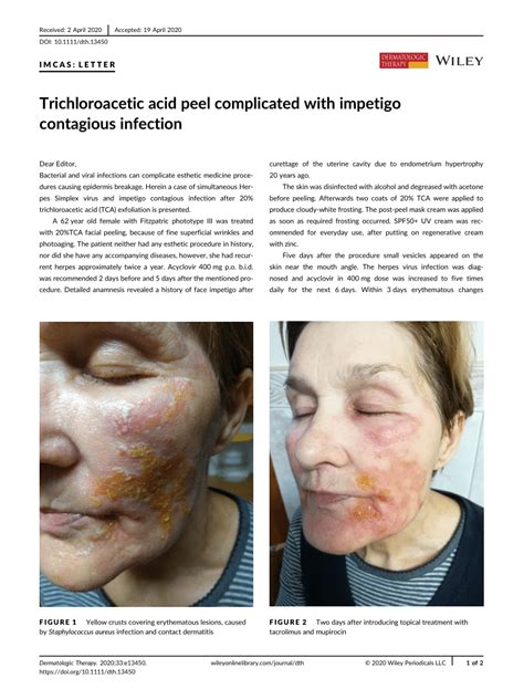 Trichloroacetic Acid Peel Complicated With Impetigo Contagious Infection