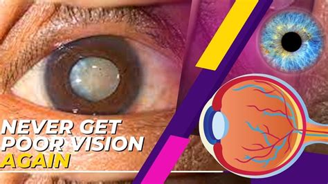 Restoration Your Eyesight Within 30 Days Restore Vision Naturally