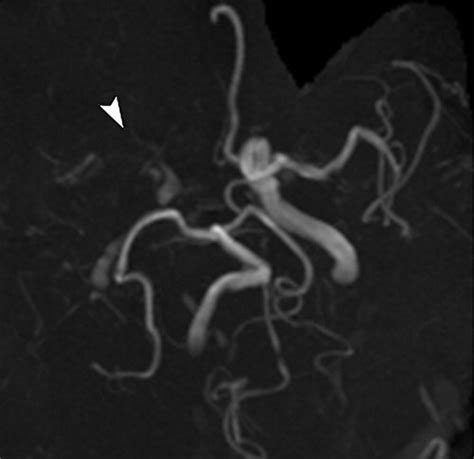 Hyperattenuating Signs At Unenhanced Ct Indicating Acute Vascular