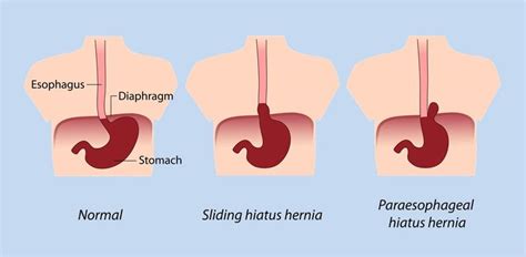 19 Best Hiatal Hernia Images On Pinterest Health Natural Medicine