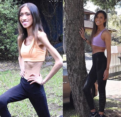 Medical Student Suffering Anorexia Nervosa Exercises Hours Daily Until Feet Comes Bleeding News