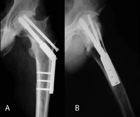 A Anteroposterior And B Lateral Radiographs Of The Hip Taken Two