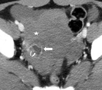 Radiological Appearances Of Corpus Luteum Cysts And Their Imaging Mimics Springerlink