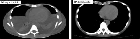 Bilateral pleural effusions with loss of bilateral costophrenic sulci (meniscus sign). Clinical course of pleural and pericardial effusion (CT ...