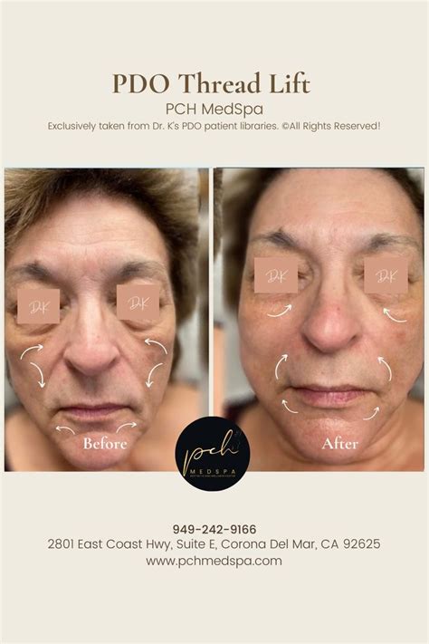 Give Your Skin That Youthful Glow With Pdo Thread Lifts You Are One