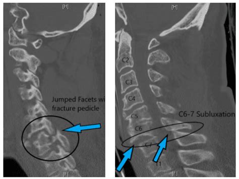 Unilateral Facet Fractures Treated Surgically And Nonoperatively 3f1