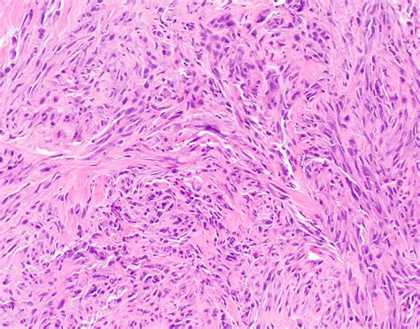 Check spelling or type a new query. Pathology Outlines - Diffuse malignant mesothelioma