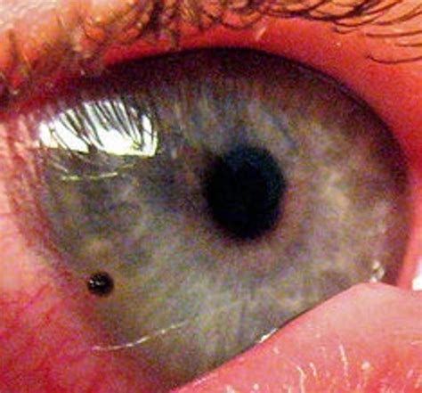 Emergency Eye Injury Treatment Hubpages