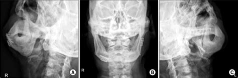 Postoperative Mandible Plain X Ray A Right Oblique B Download