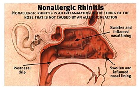 Non Allergic Rhinitis Symptoms Causes And Best Treatment