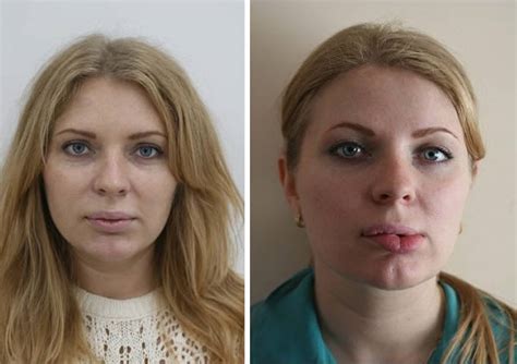 Plastic Surgery Fails 8 Lip Enhancements Gone Wrong Oddee