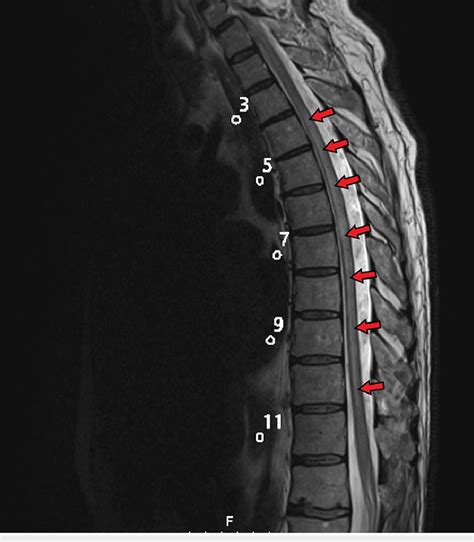 Mri Of The Thoracic Spine Patient 2 A Long Segment Of High Signal