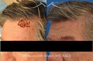 New York Facial Plastic Surgery Moh S Reconstruction Of Scalp Before