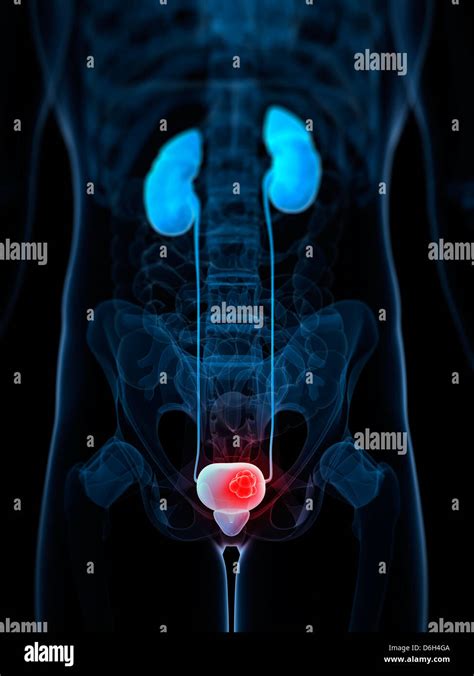 Bladder Cancer Artwork Stock Photo Alamy