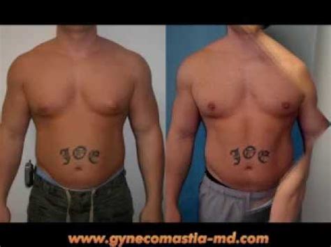 On Gynecomastia Dr Mordcai Blau Body Builders Male Breast Reduction