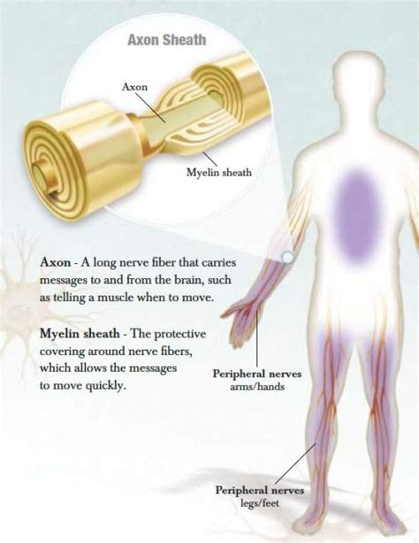 Chronic Inflammatory Demyelinating Polyneuropathy Cidp Cidp Chronic Inflammatory