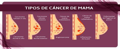 Cancer De Mama Mind Map