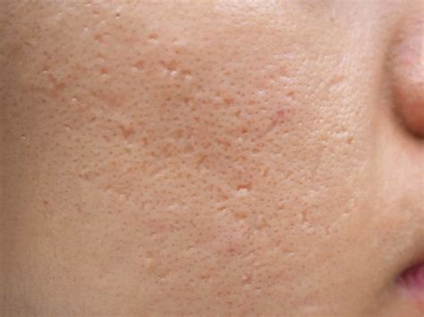 How To Get Rid Of Acne Scars And Dark Spots Panoxyl