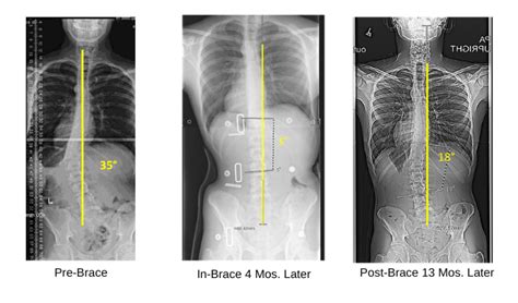 Scoliosis Bracing Reducing The Curve With The Boston Brace