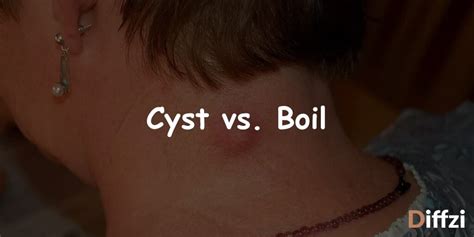 Cyst Vs Boil What Is The Difference Diffzi
