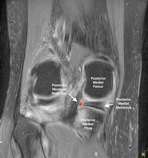 Root Tears Of The Meniscus The Hidden Tear Steve A Mora Md Hot Sex Hot Sex Picture