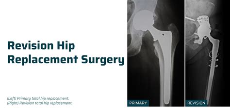 Revision Hip Replacement Surgery Ahmedabad Dr Rachit Sheth