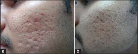 A Grade 4 Acne Scars B Improvement In Acne Scars From Grade 4 To