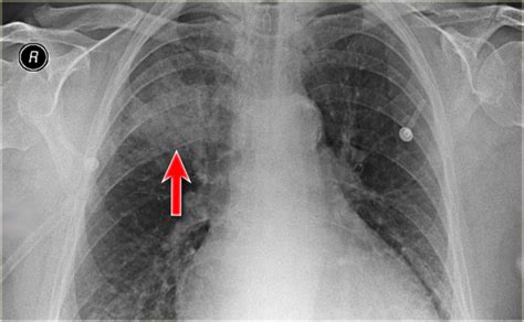 Lobar Pneumonia On The Chest X Ray There Is An Ill Defined Grepmed