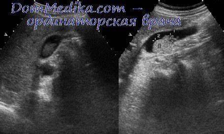 Желчнокаменная болезнь. Профилактика и лечение болезней печени Картинка - Желчнокаменная болезнь. Профилактика и лечение болезней печени