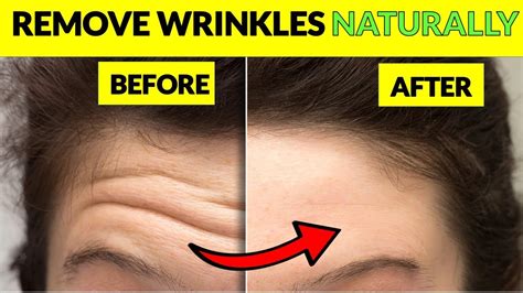 How To Get Rid Of Forehead Wrinkles Naturally Without Botox Youtube