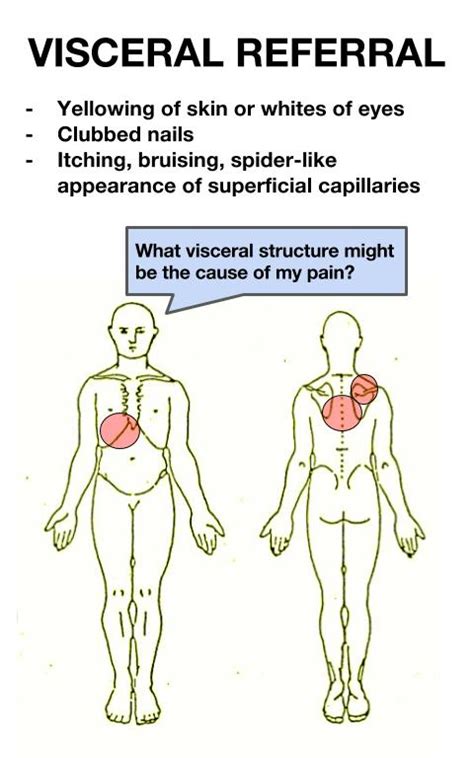 Visceral Pain Referral —