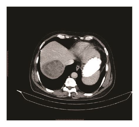Hydatid Cyst In Right Lobe Liver On Ct Scan Download Scientific Diagram