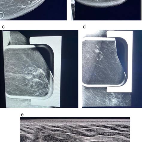 Pdf Mammographic Findings Of Diffuse Axillary Tail Trabecular