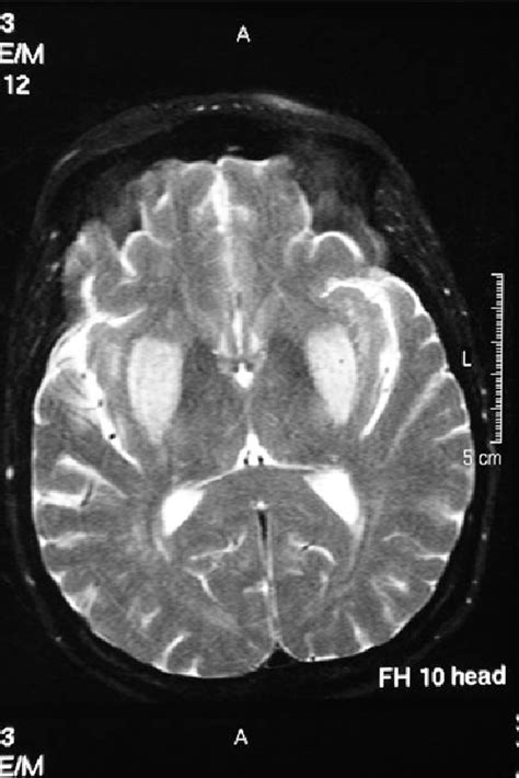 The Syndrome Of Acute Bilateral Basal Ganglia Lesions In A Patient With My Xxx Hot Girl