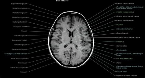 Anatomy Of Brain Mri Anatomical Charts And Posters