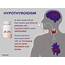 Trending Clinical Topic Hypothyroidism