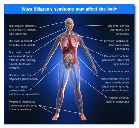 Sjogrens Sucksssss Sjogrens Syndrome Sjogrens Chronic Fatigue