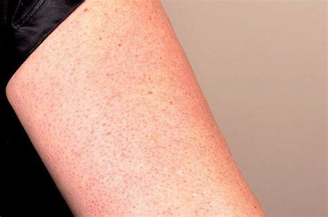 How To Get Rid Of Those Annoying Red Bumps On Your Arms