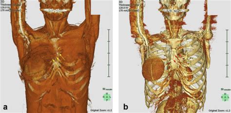 Tertiary Breast Reconstruction Using A Free Contralateral Latissimus