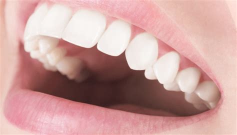 Desgaste Dental ¿cuáles Son Sus Causas Y Cómo Se Puede Corregir