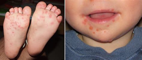 what is hand foot and mouth disease 7 questions with cassie amadio f n p wyoming medical