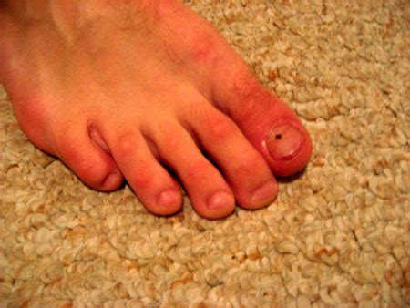 Black toenail fungusdo you have black toenail fungus? Causes And Treatments Of Black Spots On Toenails | ToeNail ...